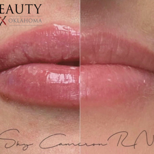 1 syringe of Lip filler