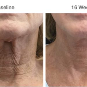 Neck Rejuvenation